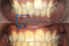 Invisalign