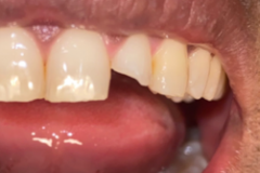 Front Teeth Restorations