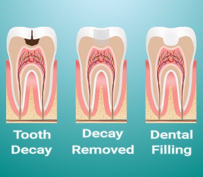 Composite Dental Fillings - My Dental Club - Cosmetics Dental fillings.