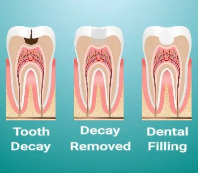 Composite Dental Filling