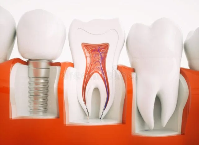 dental implants