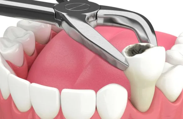 tooth extraction