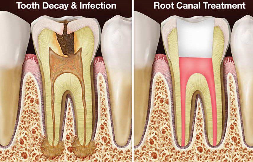 Root canal procedure time