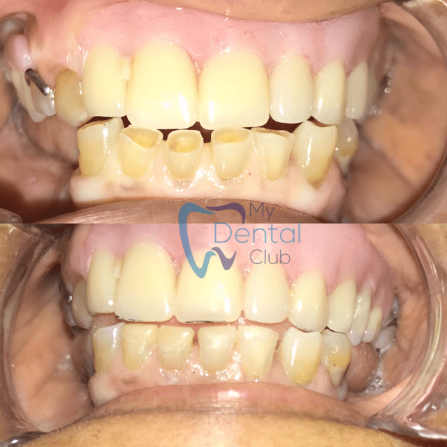 Dental Bonding. Dental Shaping . Shaping & Contouring