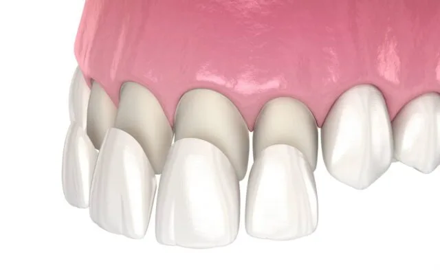 veneers , dental veneers, veneers trinidad , invisalign dentist trinidad