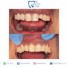Fillings