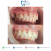 Front Fillings