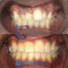 Before and after Invisalign treatment for crowding and crossbite by affordable Trinidad dentist My Dental Club TT showing improved alignment and bite correction