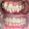 Before and after dental treatment showing teeth alignment correction by affordable Trinidad dentist My Dental Club TT