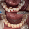 Before and after lower teeth alignment correction by affordable Trinidad dentist My Dental Club TT showing improved gum health and alignment
