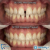 Before and after Invisalign treatment for teeth spacing by affordable Trinidad dentist My Dental Club TT showing closed gaps and improved alignment
